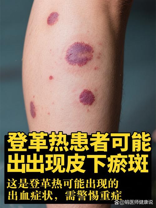 常州现首例登革热输入病例，国内无疫苗，防蚊灭蚊很关键